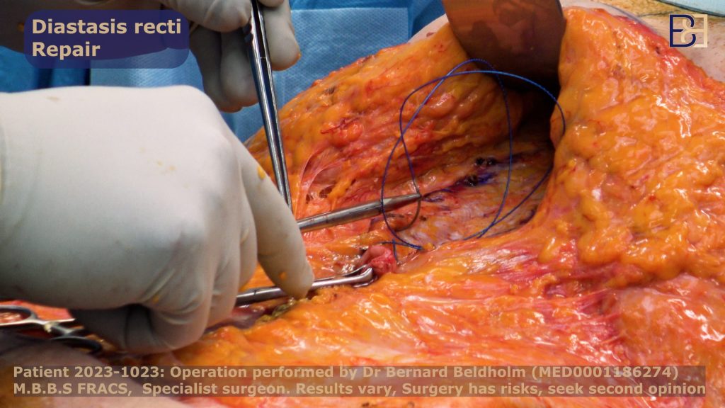 Diastasis Recti Repair