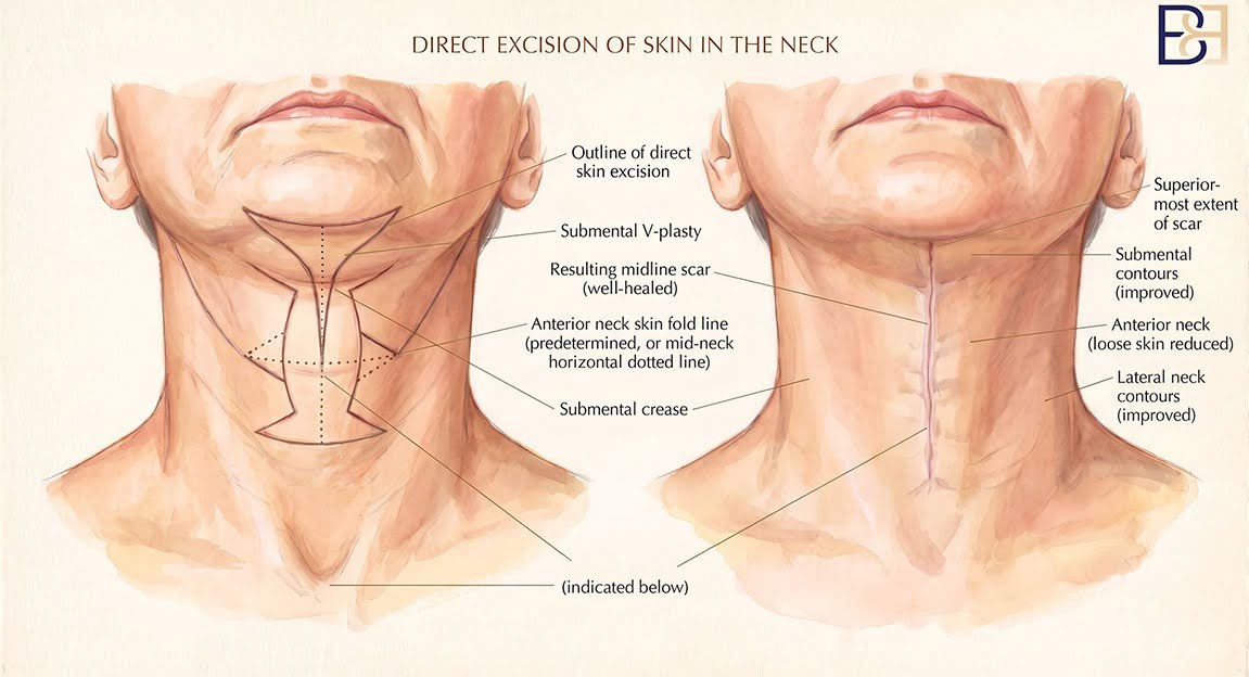 Direct Excision of Neck Skin