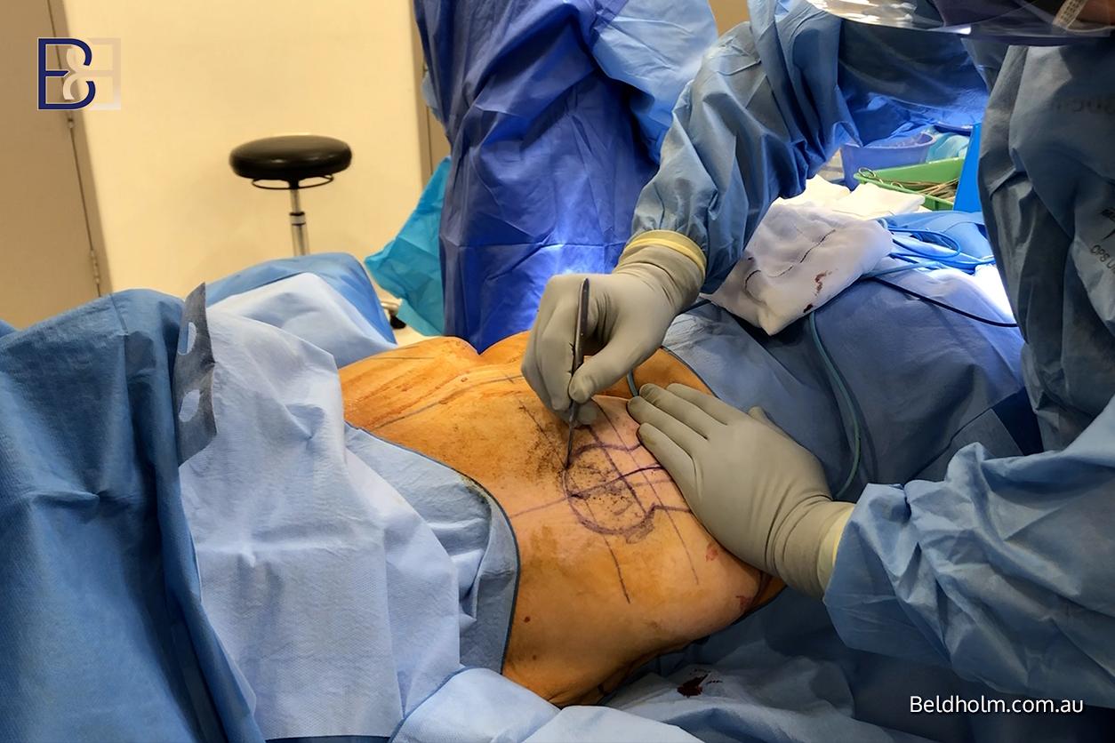 Dr Beldholm performing breast lift