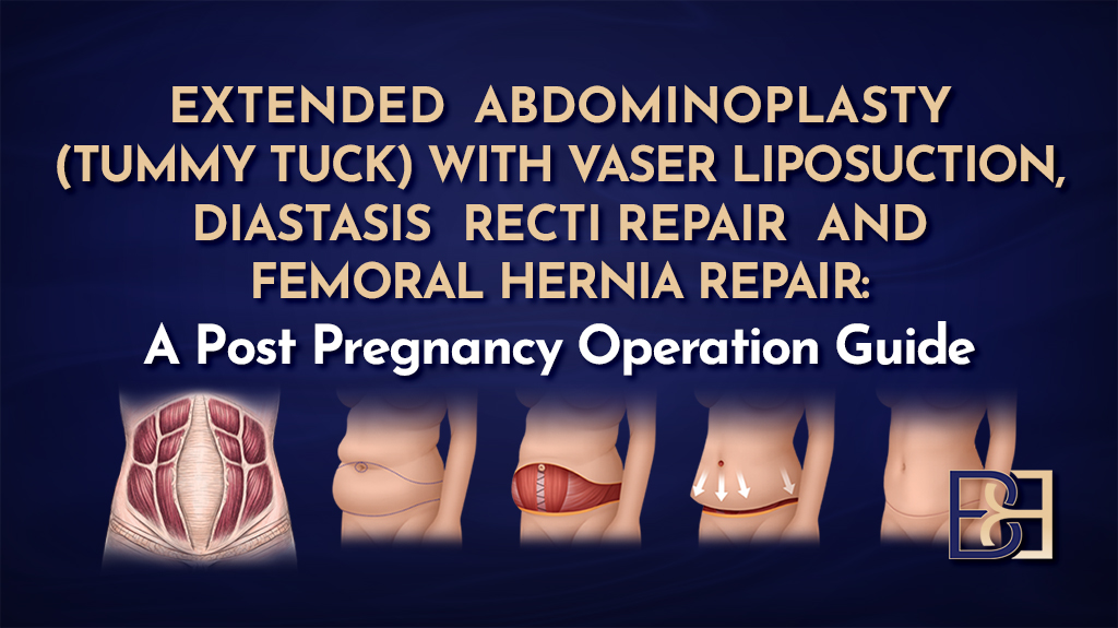 Extended Abdominoplasty Diastasis Recti Repair and Femoral Hernia Repair-featured image