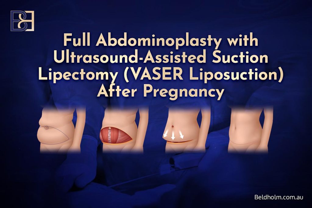 Full Abdominoplasty with Ultrasound-Assisted Suction Lipectomy (VASER Liposuction) After Pregnancy 1 Full Abdominoplasty with Ultrasound-Assisted Suction Lipectomy (VASER Liposuction) After Pregnancy