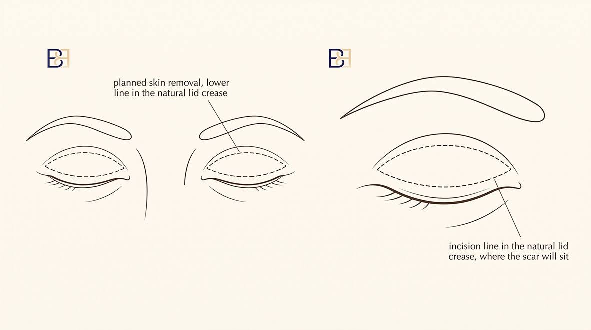 Upper Blepharoplasty (Upper Eyelid Surgery) 3 How I perform an upper blepharoplasty