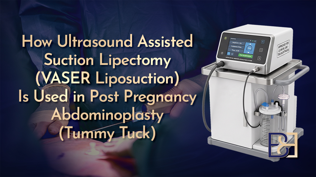 How Ultrasound-Assisted Suction Lipectomy) Is Used in Post Pregnancy Abdominoplasty-Featured image