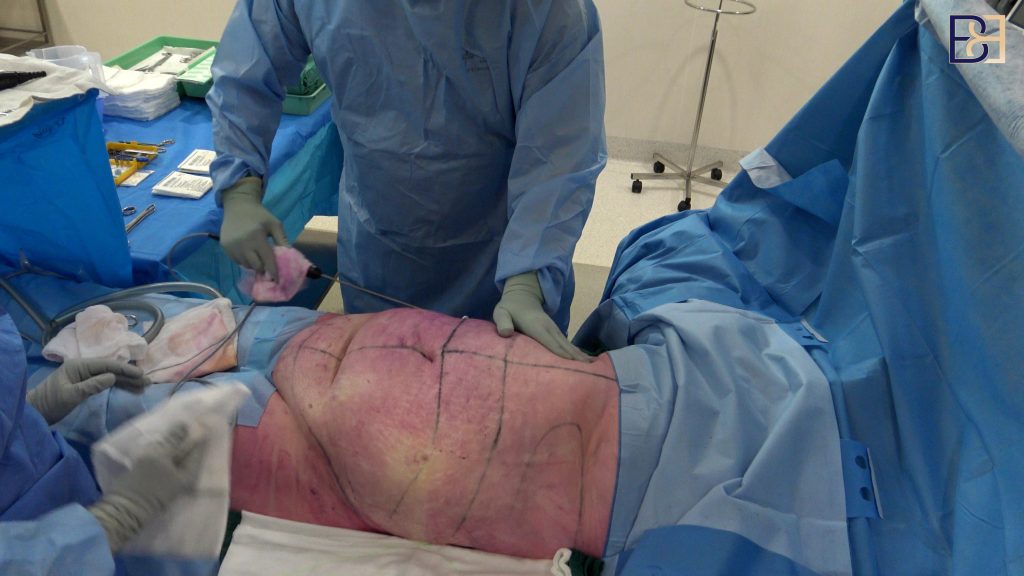 Limited Abdominoplasty (Mini Tummy Tuck) With VASER Liposuction for Loose Lower Abdominal Skin After Pregnancy 4 How Ultrasound-Assisted Suction Lipectomy (VASER Liposuction) Is Used in Post Pregnancy Abdominoplasty (Tummy Tuck)