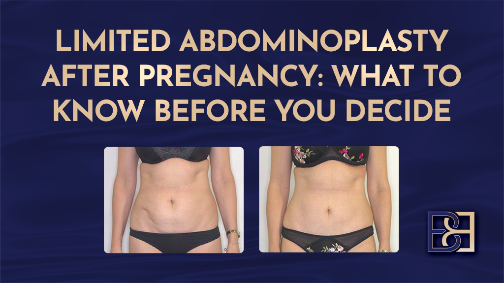 Limited Abdominoplasty After Pregnancy What to Know Before You Decide-Featured image