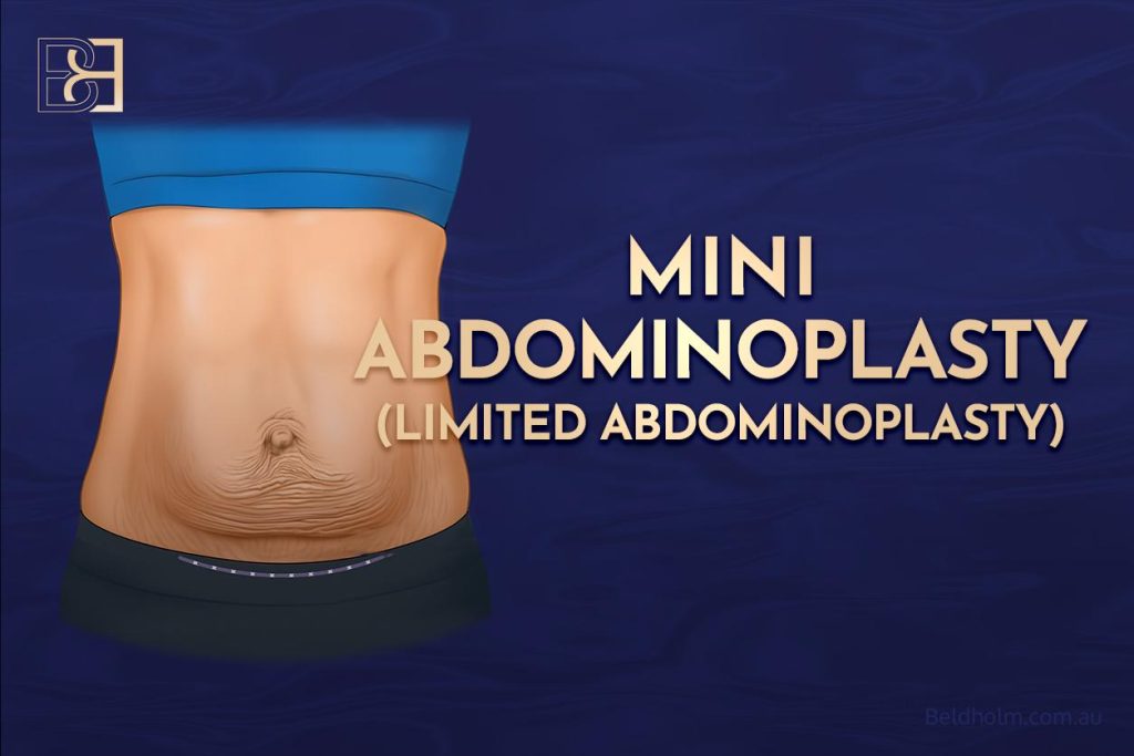 Limited Abdominoplasty (Tummy Tuck) After Pregnancy 1 Limited Abdominoplasty (Tummy Tuck) After Pregnancy