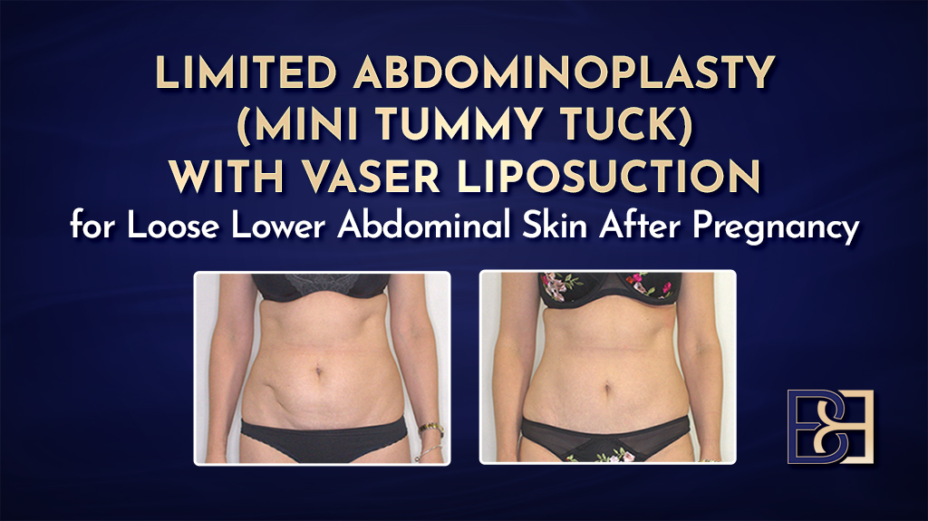 Limited Abdominoplasty VASER Liposuction for Loose Lower Abdominal Skin After Pregnancy-featured image