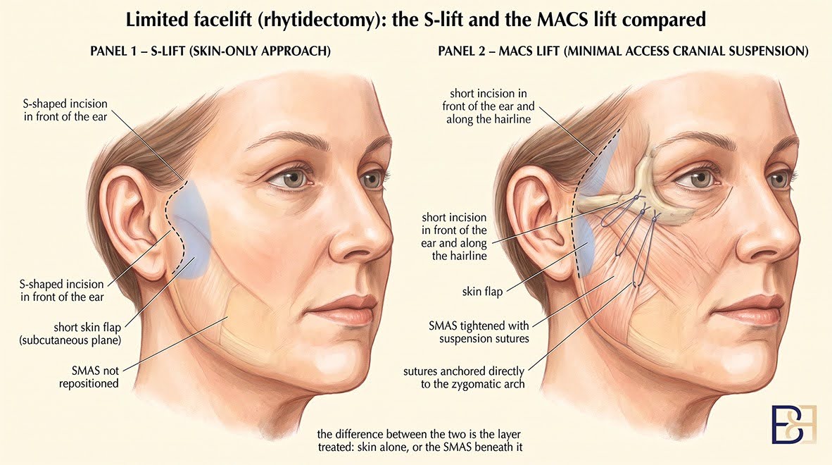 Mini Facelift (Limited Rhytidectomy) in Newcastle NSW 2 Limited Facelift (Rhytidectomy)