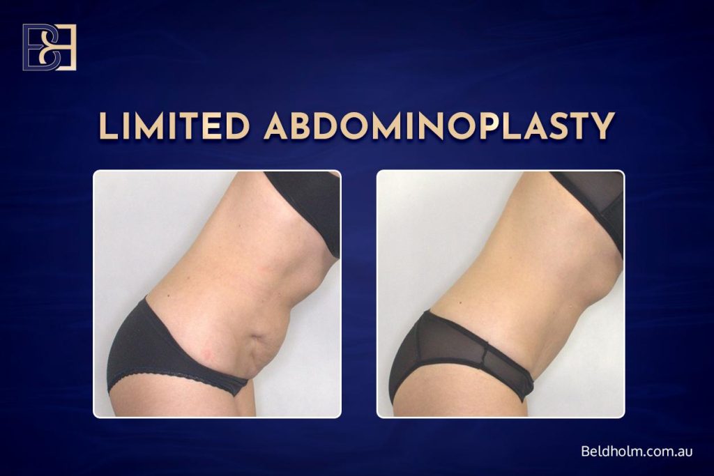 Limited abdominoplasty