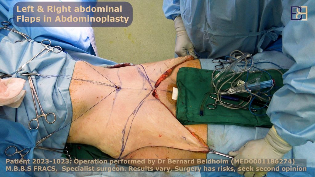 Marking and removing the excess skin