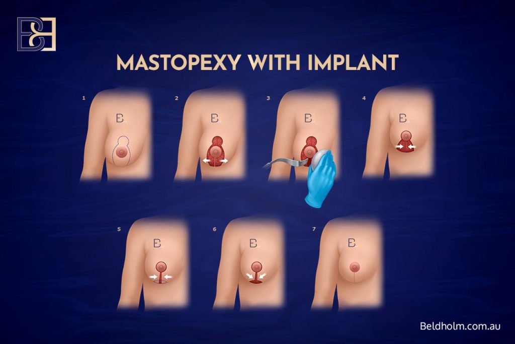 Mastopexy with Implant