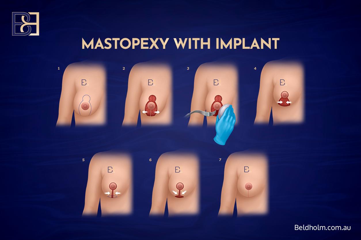 Mastopexy with Implant