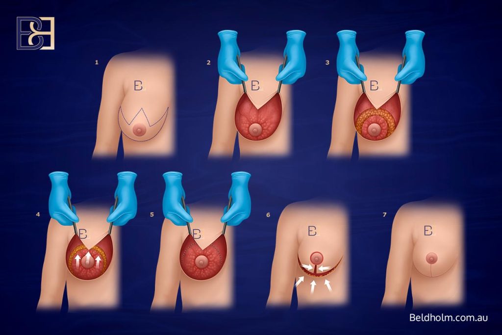Mastopexy with auto-augmentation - Dr Bernard Beldholm