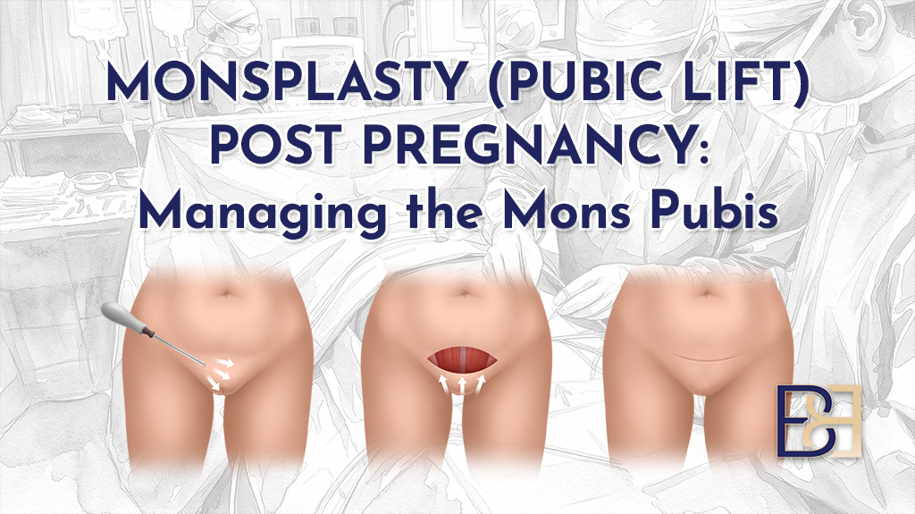 Monsplasty (Pubic Lift) Post Pregnancy Managing the Mons Pubis-featured image