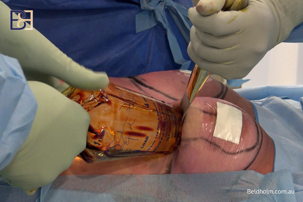 Placing the new implants