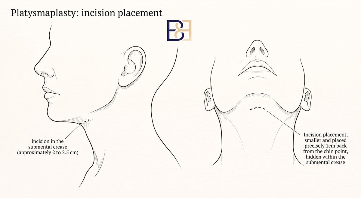 Platysmaplasty incision placement