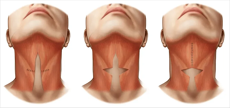 Platysmaplasty incision