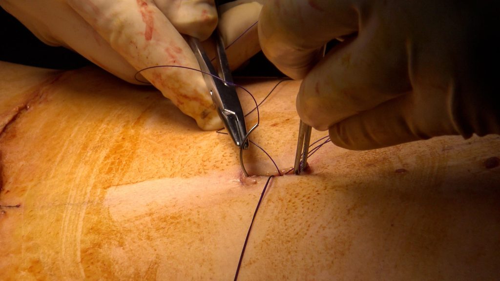 Redraping the skin and setting the umbilicus
