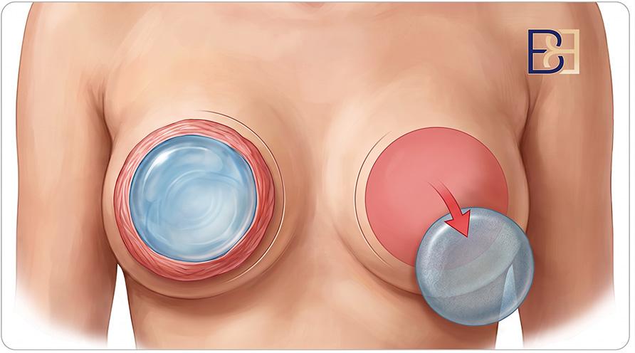 Removal of Breast Implants (Explant Surgery) - Dr Bernard Beldholm