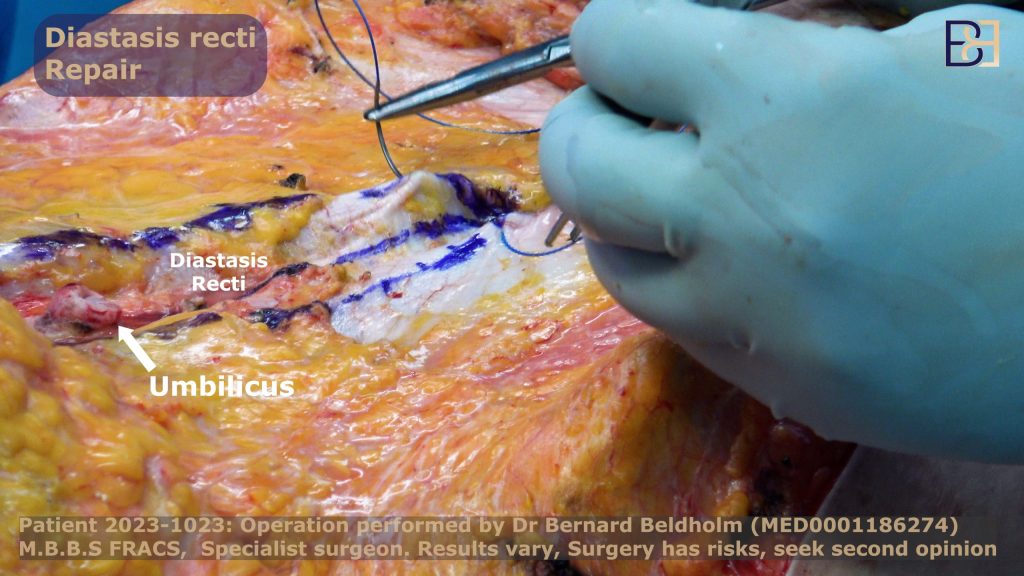 Repairing the diastasis recti (muscle separation)