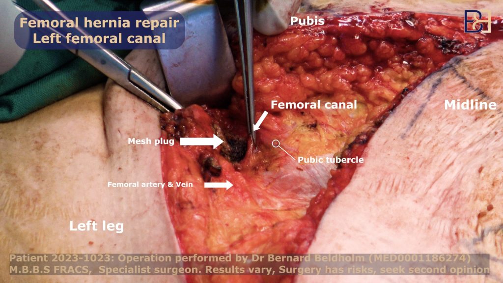 Repairing the femoral hernia through the same incision