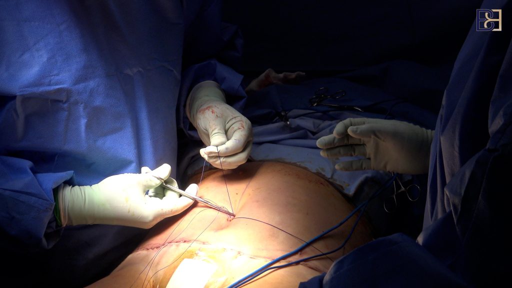 Scars and healing around the umbilicus