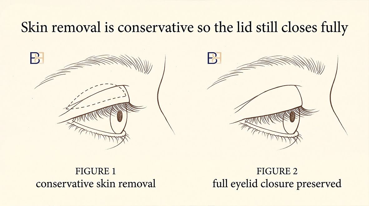 Upper Blepharoplasty (Upper Eyelid Surgery) 4 Skin removal is conservative so the lid still closes fully