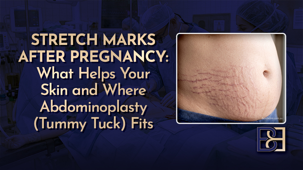 Stretch Marks After Pregnancy What Helps Your Skin and Where Abdominoplasty (Tummy Tuck) Fits-featured image