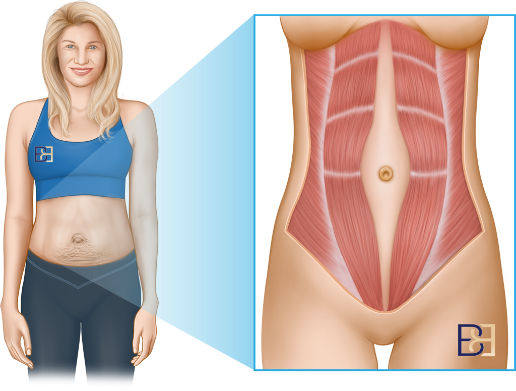 Abdominoplasty (Tummy Tuck) After a Caesarean: Timing and Why I Operate Separately 6 The abdominal muscles