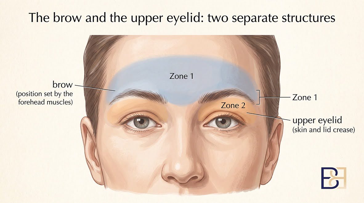 Upper Blepharoplasty (Upper Eyelid Surgery) 2 The brow and upper eyelid