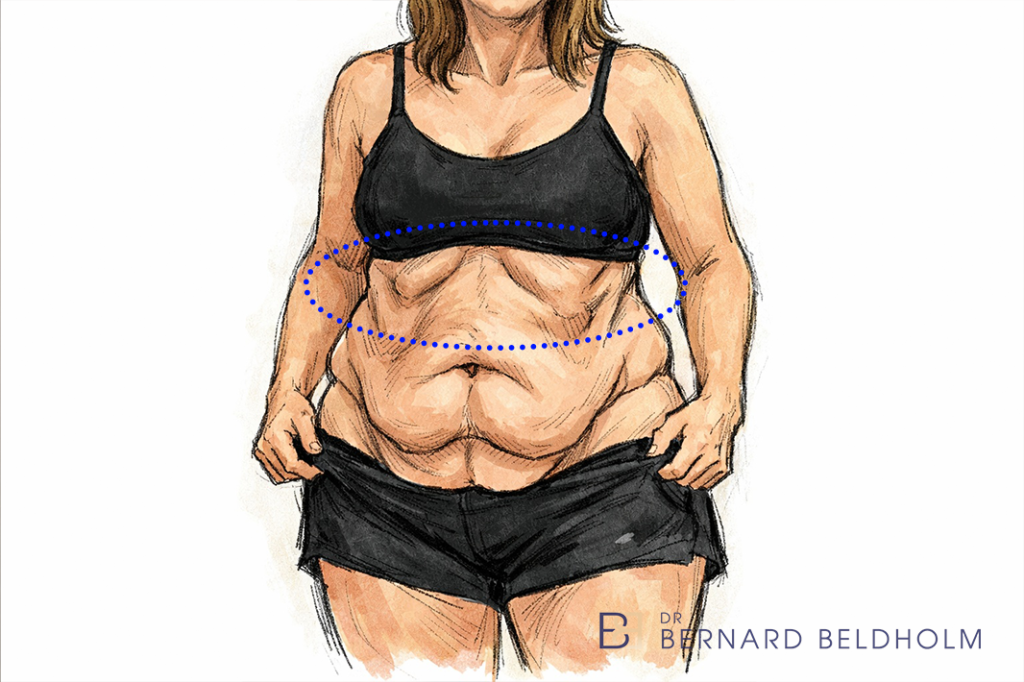 Dual Vector Abdominoplasty: Combining Fleur de Lis Abdominoplasty with Upper Abdominal Lipectomy 10 The zone it cannot reach