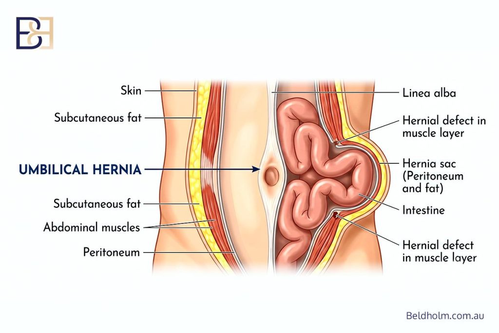 Umbilical hernia