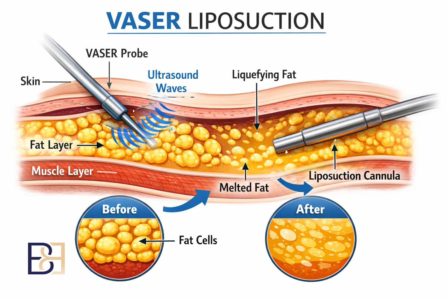 VASER Liposuction