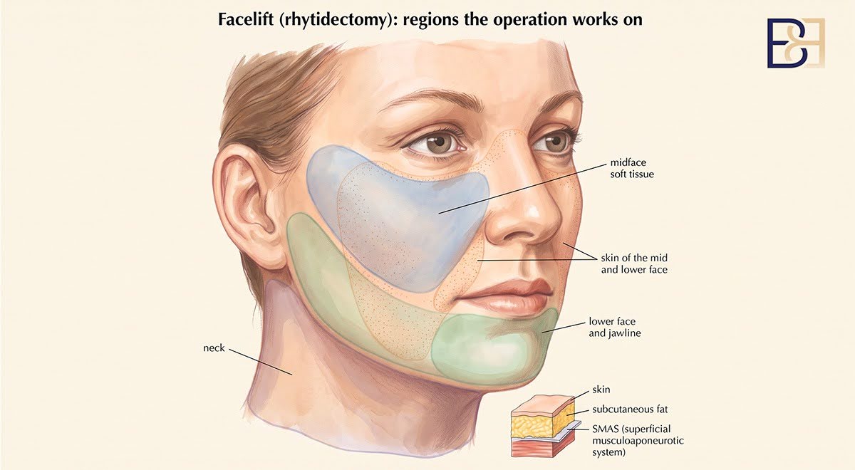 Neck Lift (Cervicoplasty) 2 What a neck lift (cervicoplasty) is suited to
