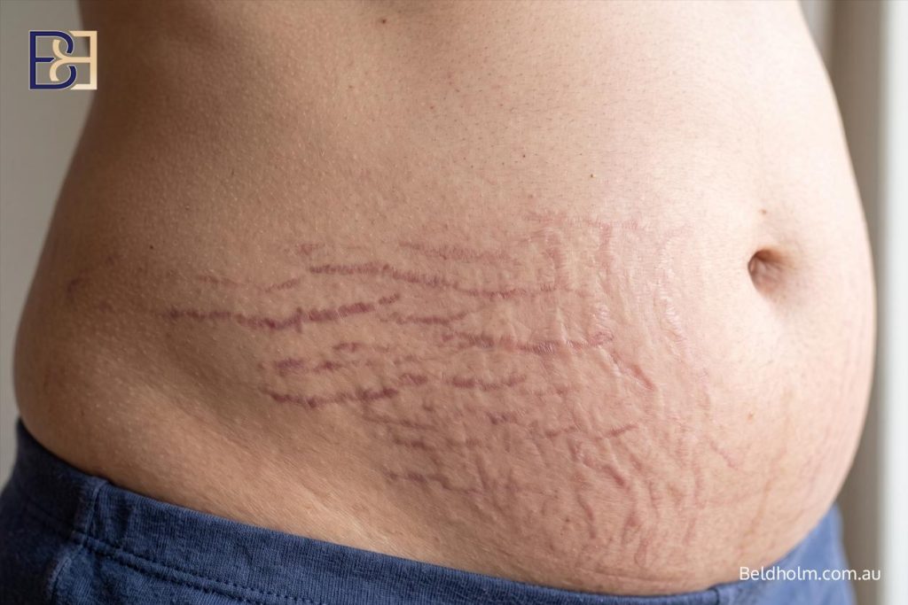 Stretch Marks After Pregnancy: What Helps Your Skin and Where Abdominoplasty (Tummy Tuck) Fits 3 What stretch marks are and why they form