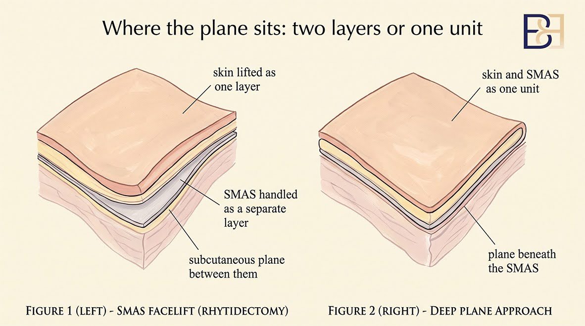 Where the plane sits - Facelift (Rhytidectomy)