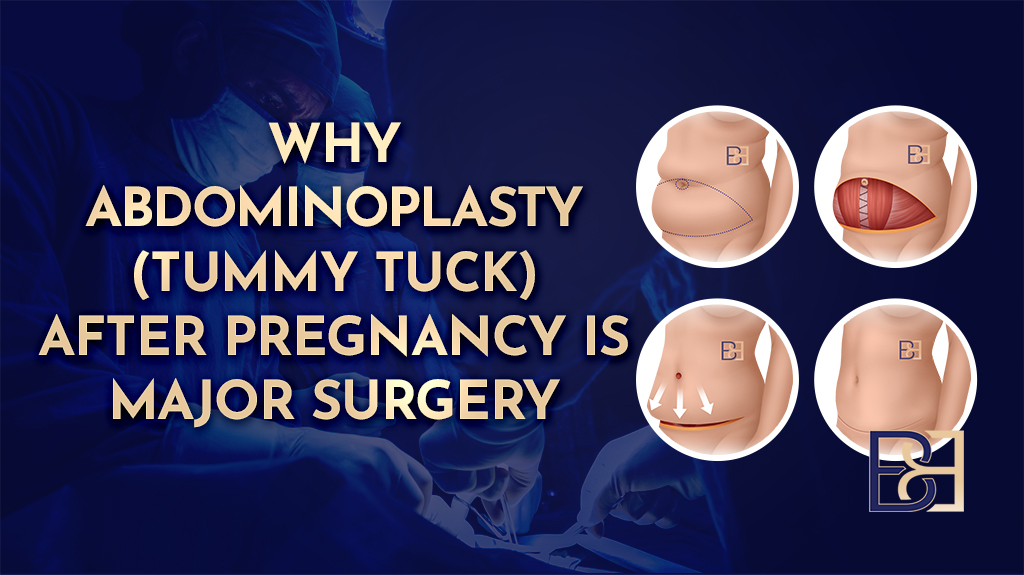 Why Abdominoplasty (Tummy Tuck) After Pregnancy Is Major Surgery-featued image