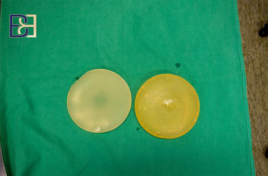Why patients consider implant removal