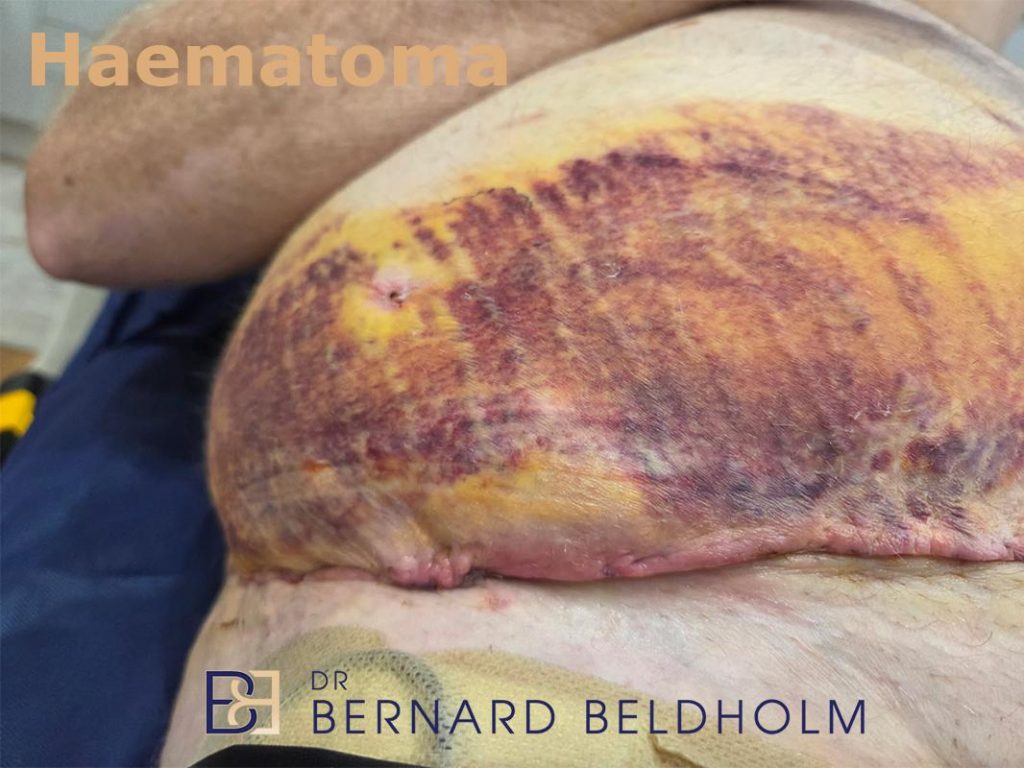 Haematoma