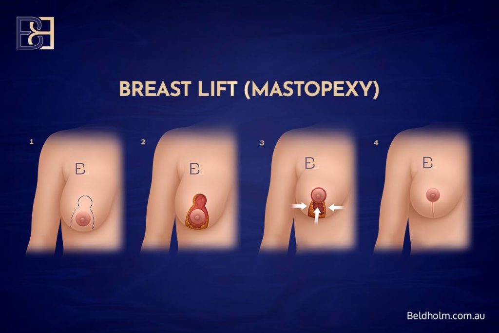 A standard breast lift