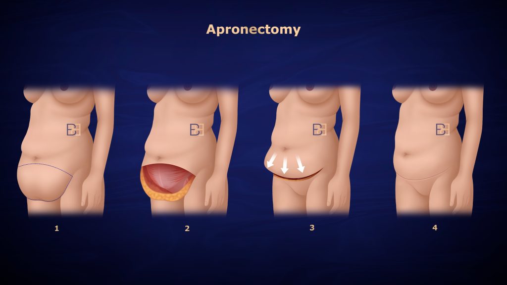 An illustration of the apronectomy procedure showing the surgical process