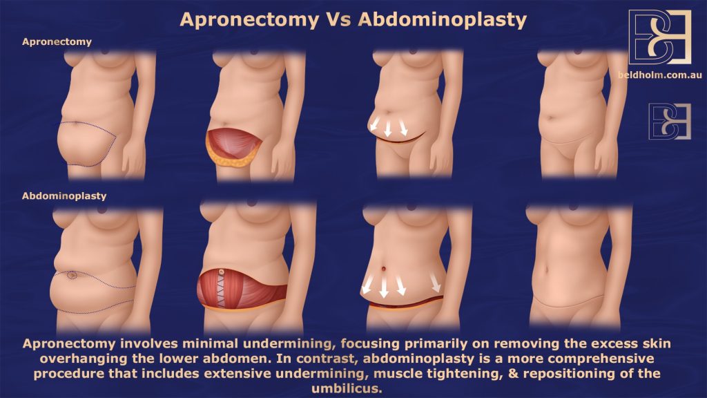 Apronectomy vs Abdominoplasty