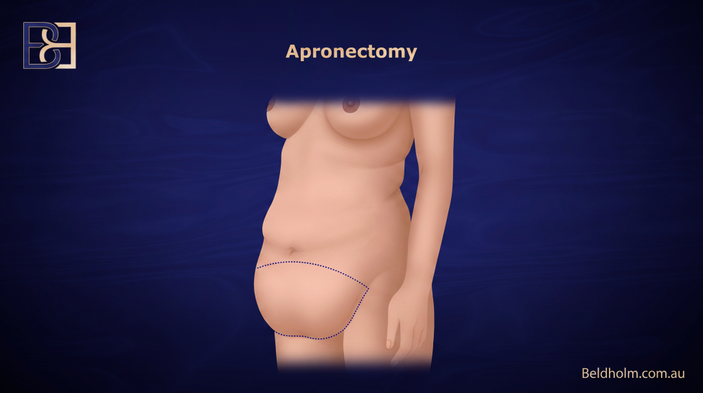 Markings - Apronectomy