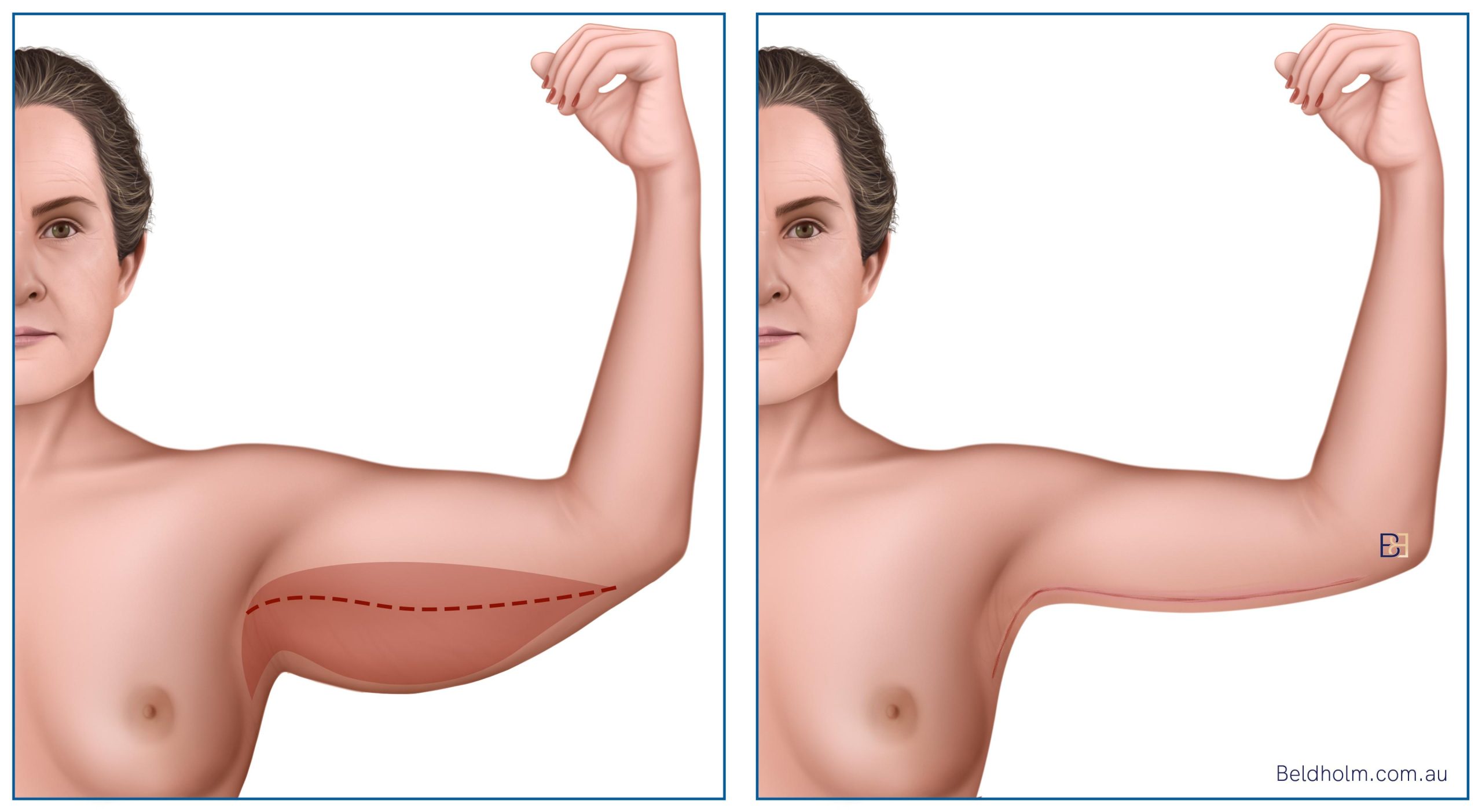 Assessing the Arm: How I Classify Skin Excess