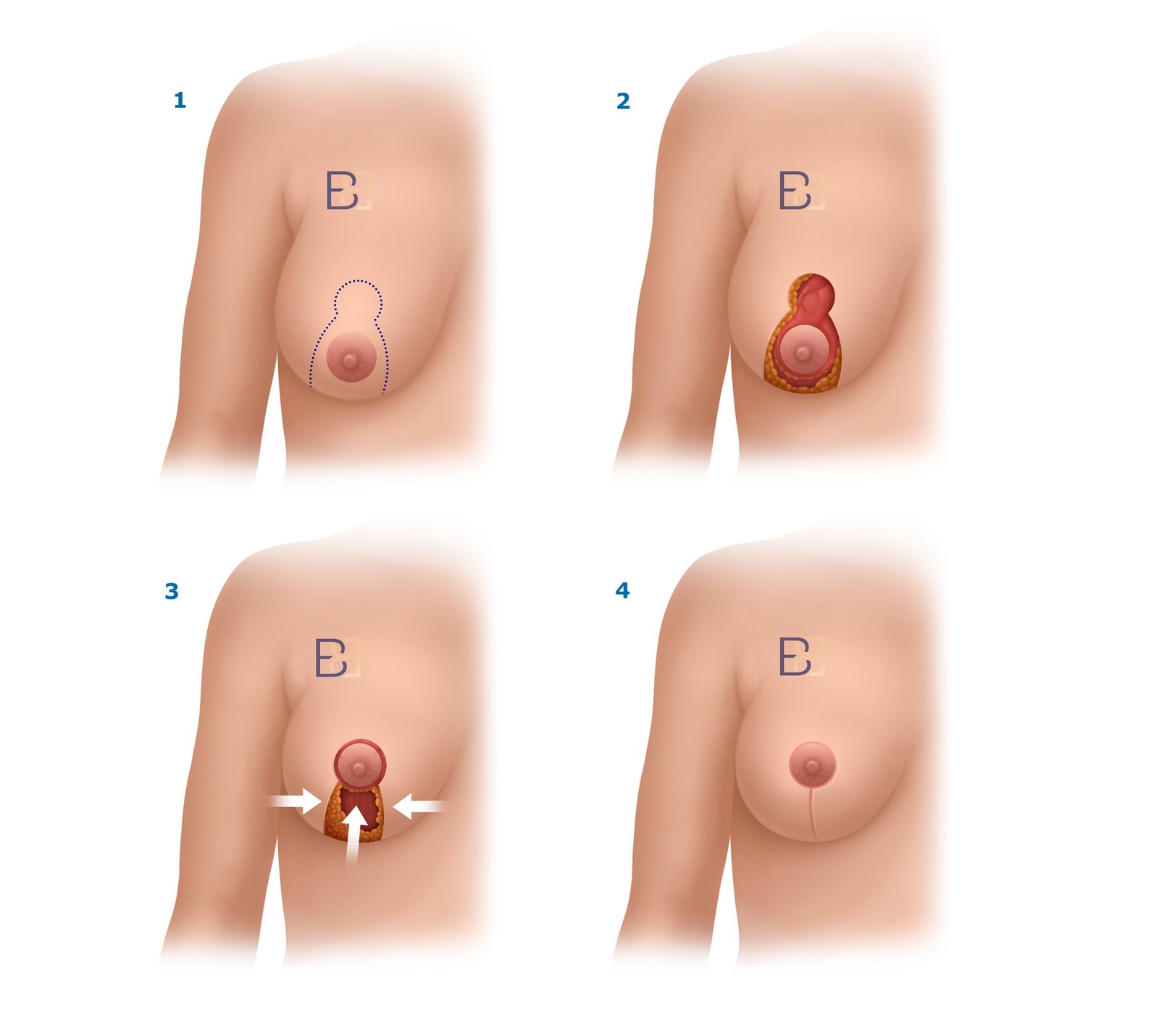 Breast Reduction (Reduction Mammoplasty) for Heavy or Symptomatic Breasts 3 Vertical pattern breast reduction (reduction mammoplasty) in 4 steps