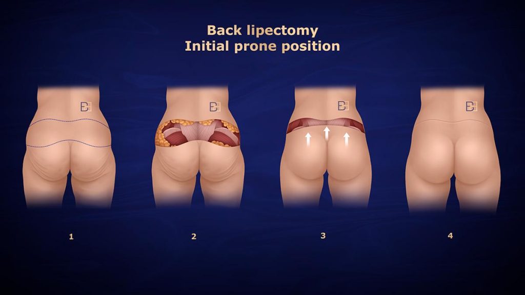 Back Lipectomy - Initial Prone Position