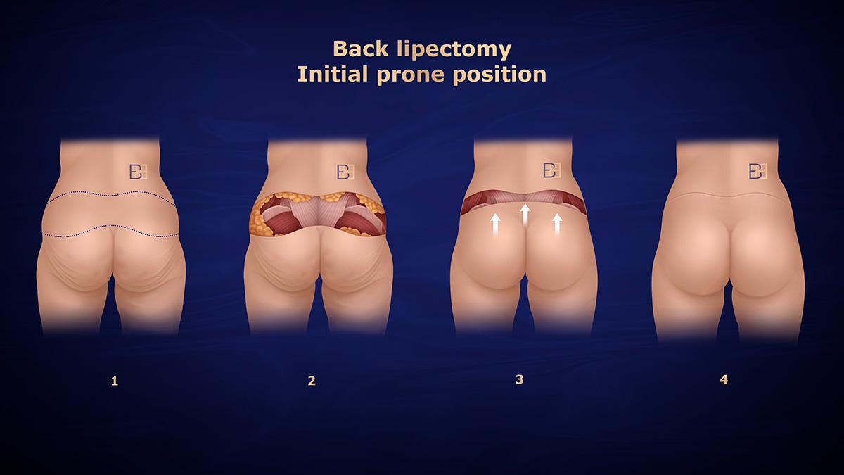Back Lipectomy - Initial Prone Position