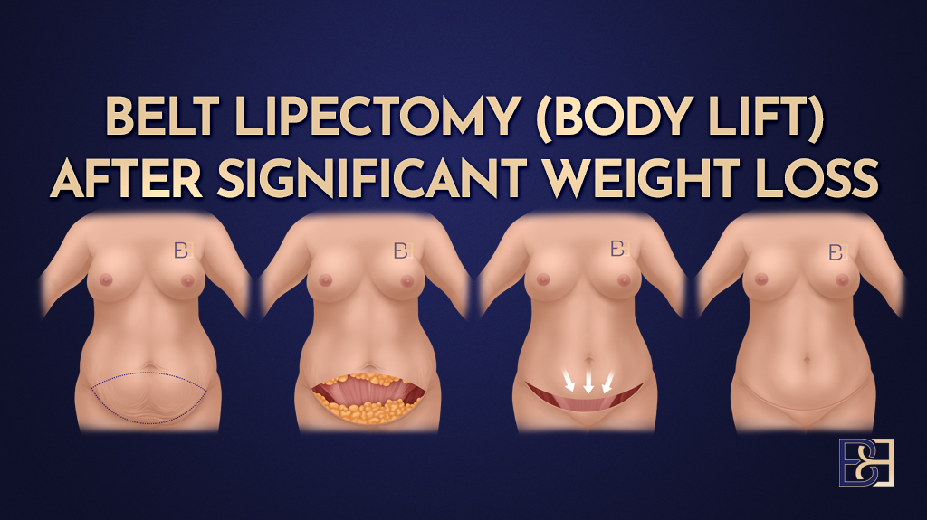 Belt lipectomy (Body Lift) after Significant Weight loss-featured image