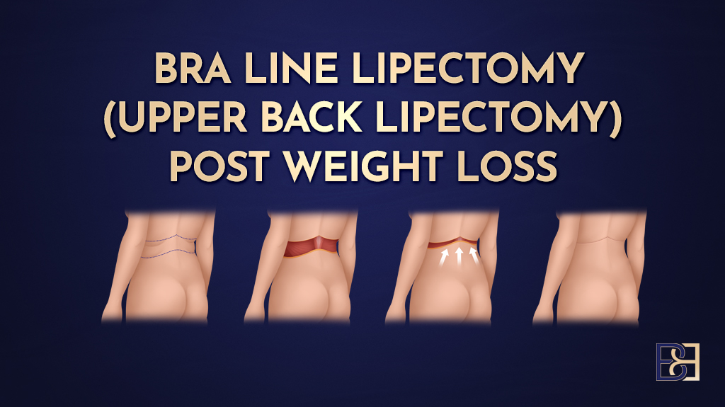 Bra line Lipectomy (Upper Back lipectomy) post weight loss-featured image