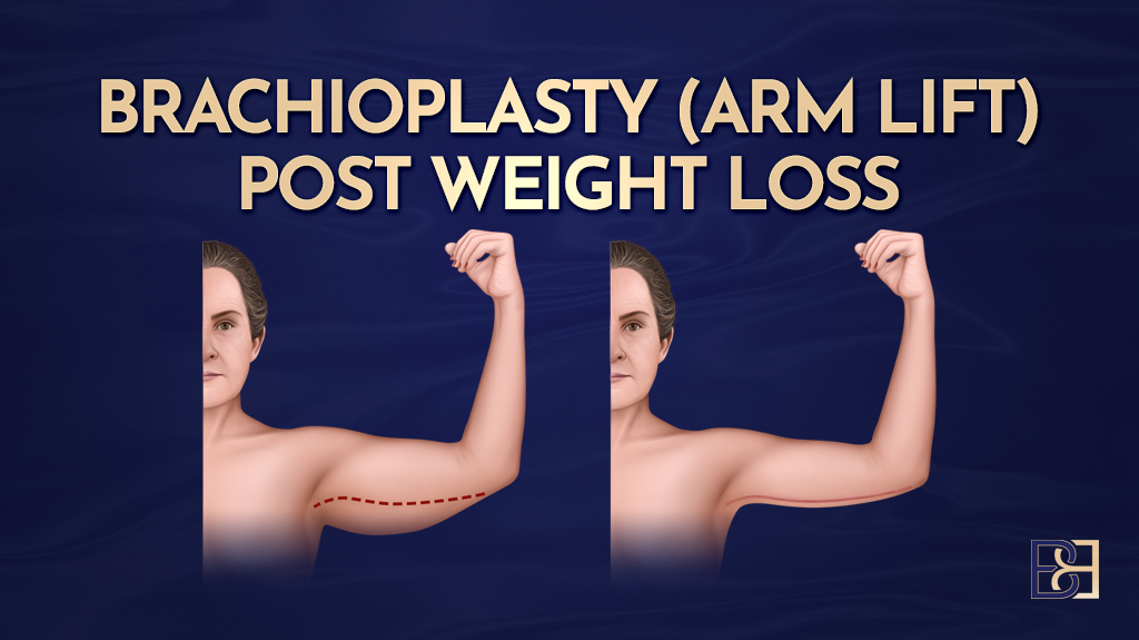 Brachioplasty (Arm Lift) post weight loss-featured image